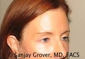 Browlift Before and After 09 | Sanjay Grover MD FACS