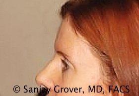 Browlift Before and After 09 | Sanjay Grover MD FACS