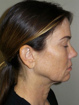 Facelift Before and After 04 | Sanjay Grover MD FACS