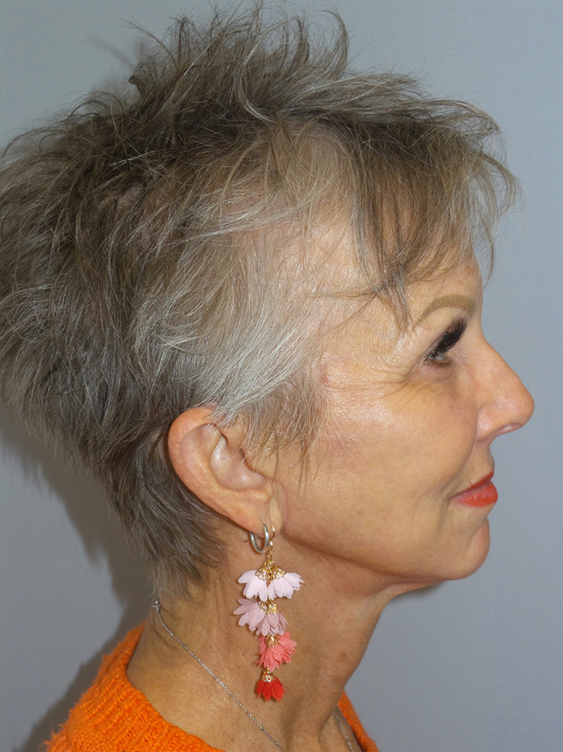 Facelift Before and After 06 | Sanjay Grover MD FACS