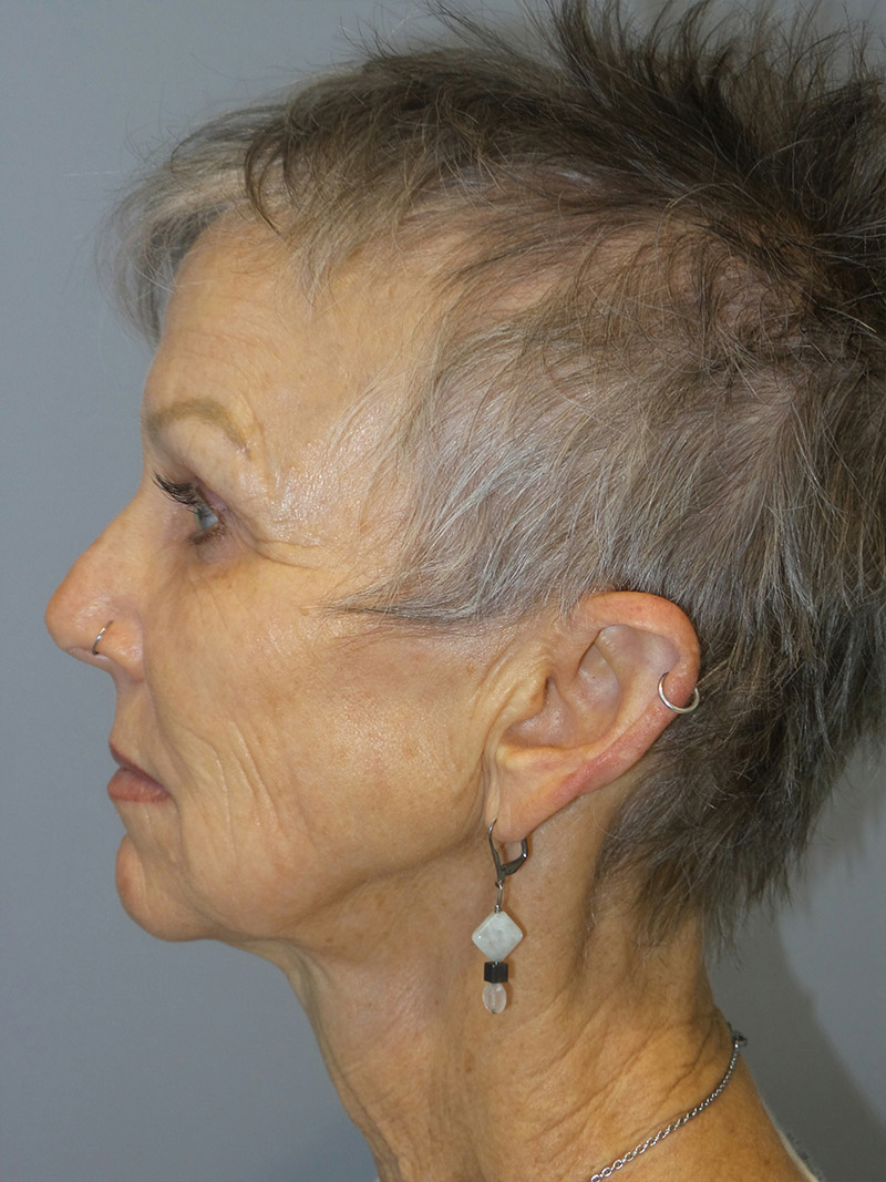 Facelift Before and After 06 | Sanjay Grover MD FACS