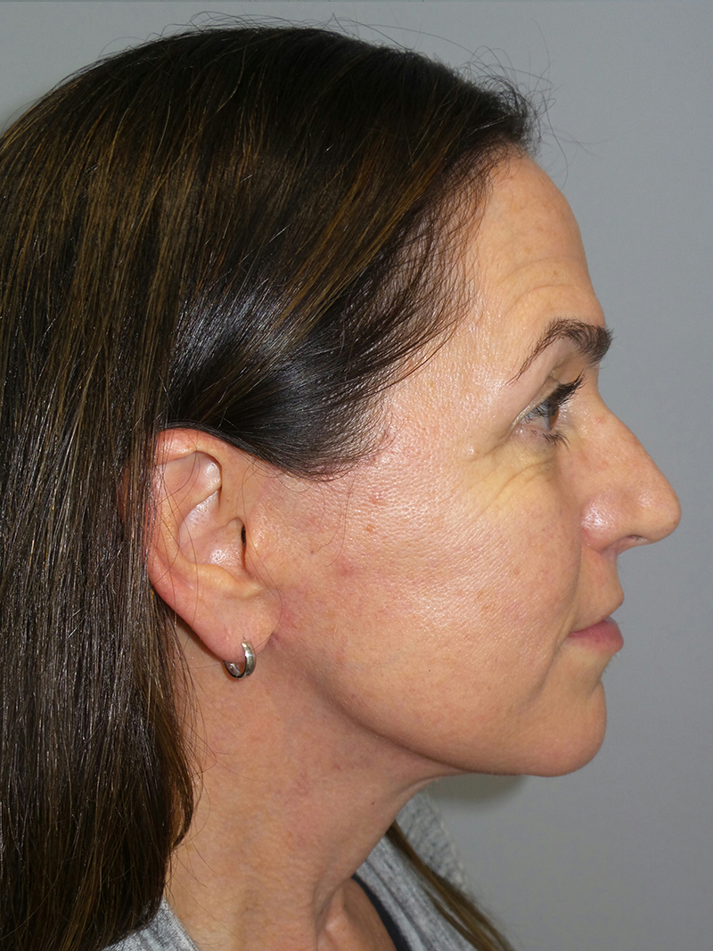 Facelift Before and After 07 | Sanjay Grover MD FACS