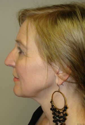 Facelift Before and After 07 | Sanjay Grover MD FACS