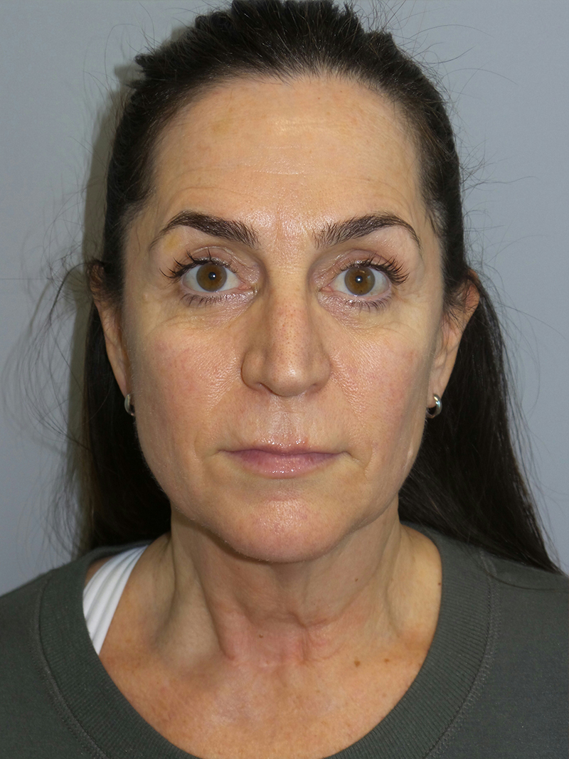 Facelift Before and After 07 | Sanjay Grover MD FACS