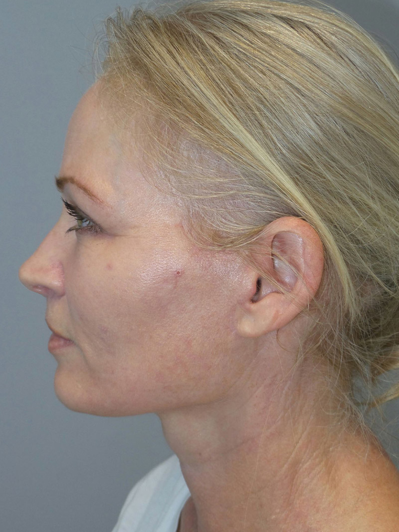 Facelift Before and After 08 | Sanjay Grover MD FACS