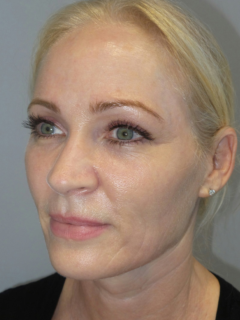 Facelift Before and After 09 | Sanjay Grover MD FACS