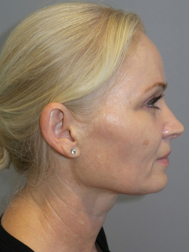 Facelift Before and After 09 | Sanjay Grover MD FACS