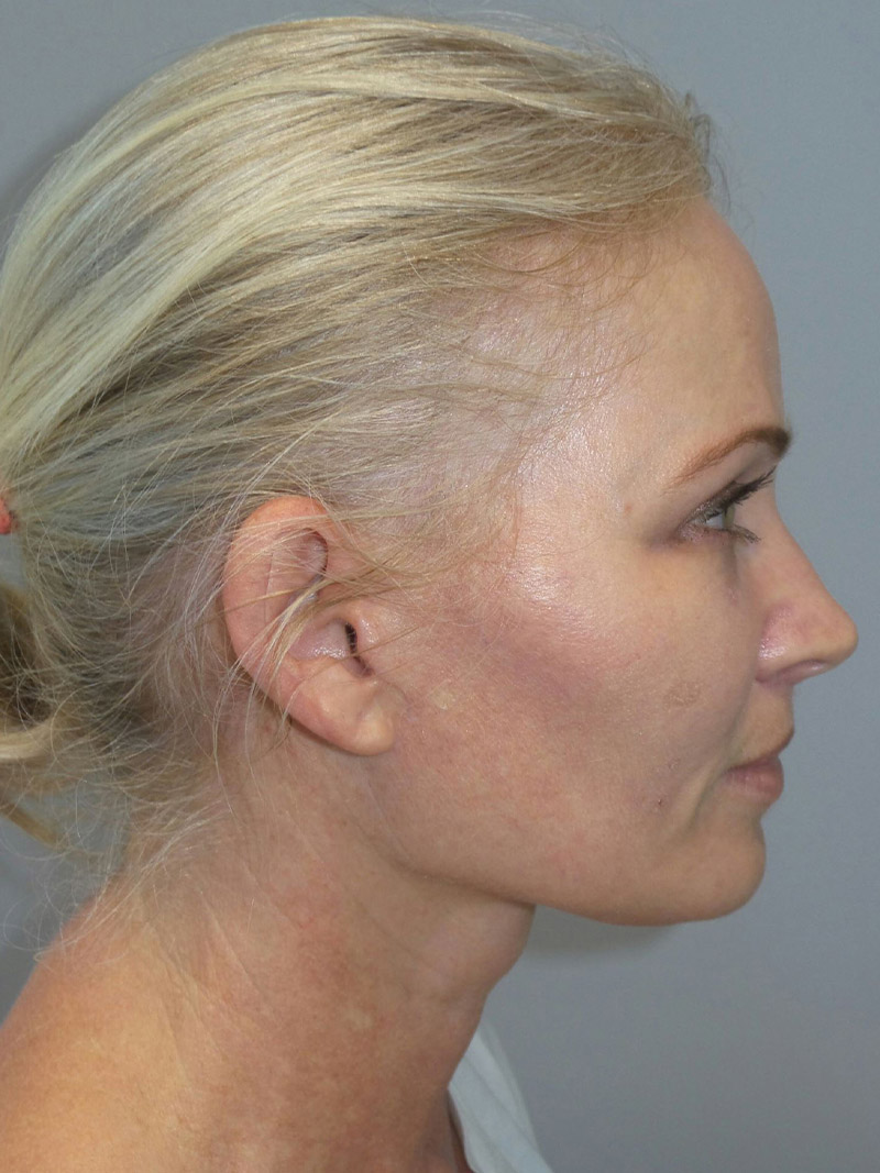 Facelift Before and After 09 | Sanjay Grover MD FACS