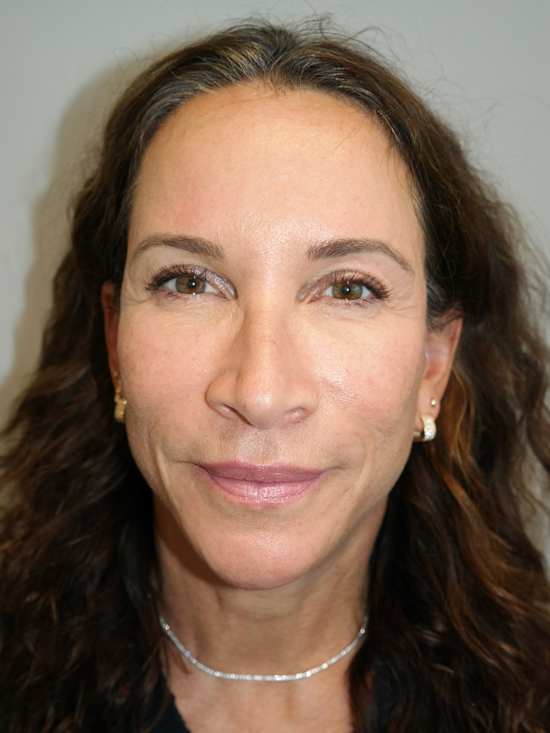 Facelift Before and After 11 | Sanjay Grover MD FACS