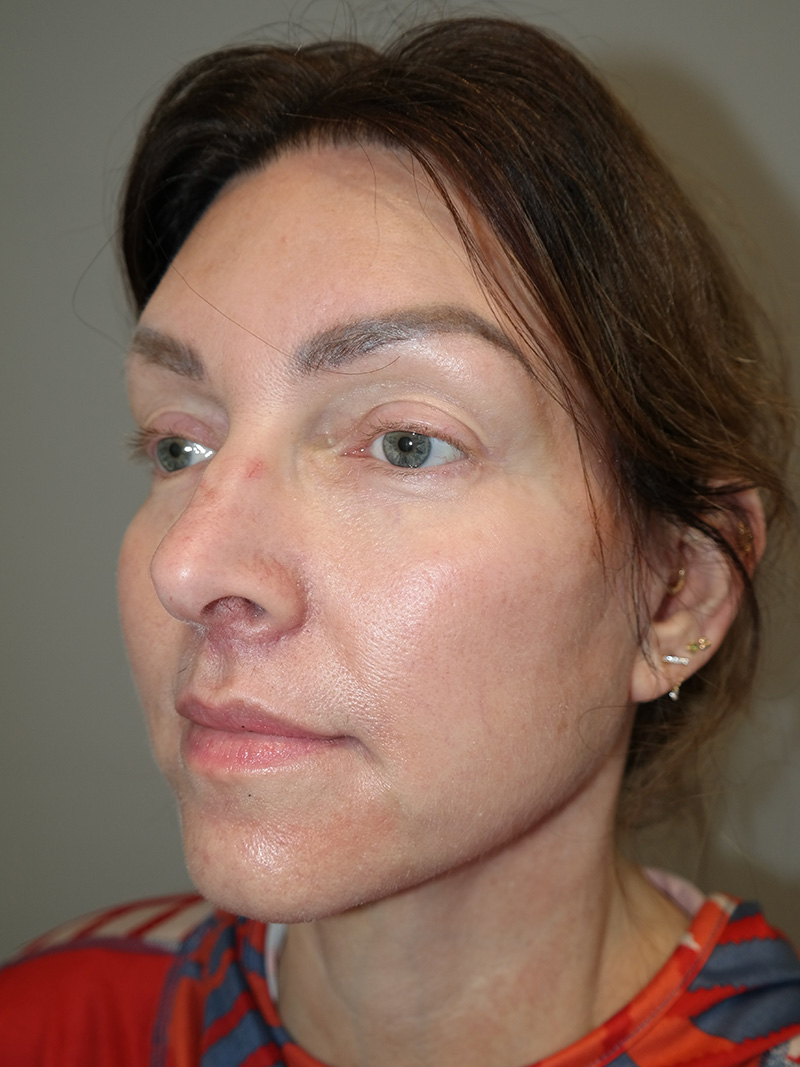 Facelift Before and After 11 | Sanjay Grover MD FACS