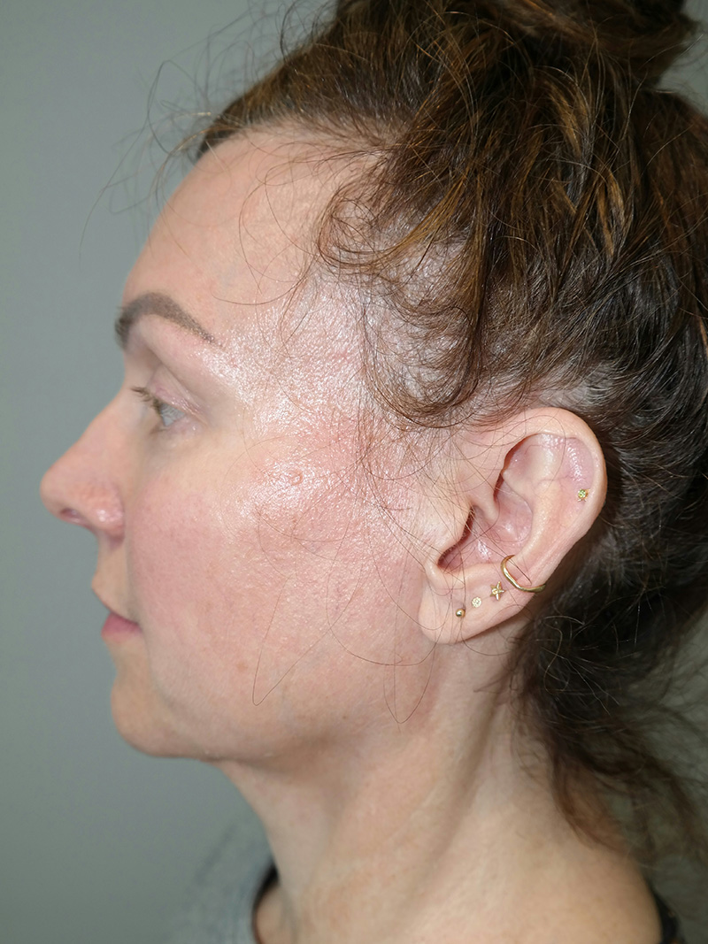 Facelift Before and After 11 | Sanjay Grover MD FACS