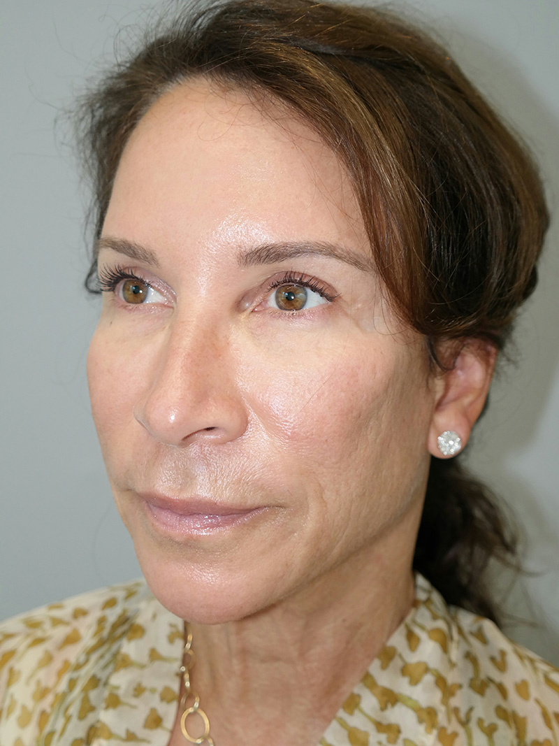 Facelift Before and After 12 | Sanjay Grover MD FACS