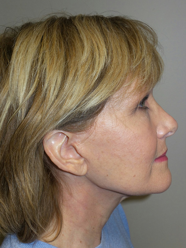 Facelift Before and After 13 | Sanjay Grover MD FACS