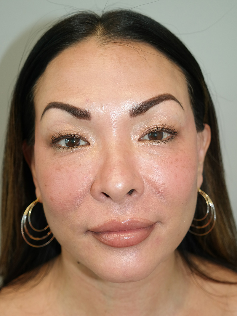 Facelift Before and After 14 | Sanjay Grover MD FACS