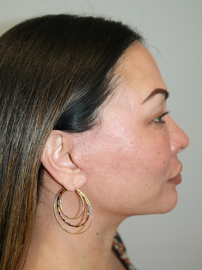 Facelift Before and After 14 | Sanjay Grover MD FACS