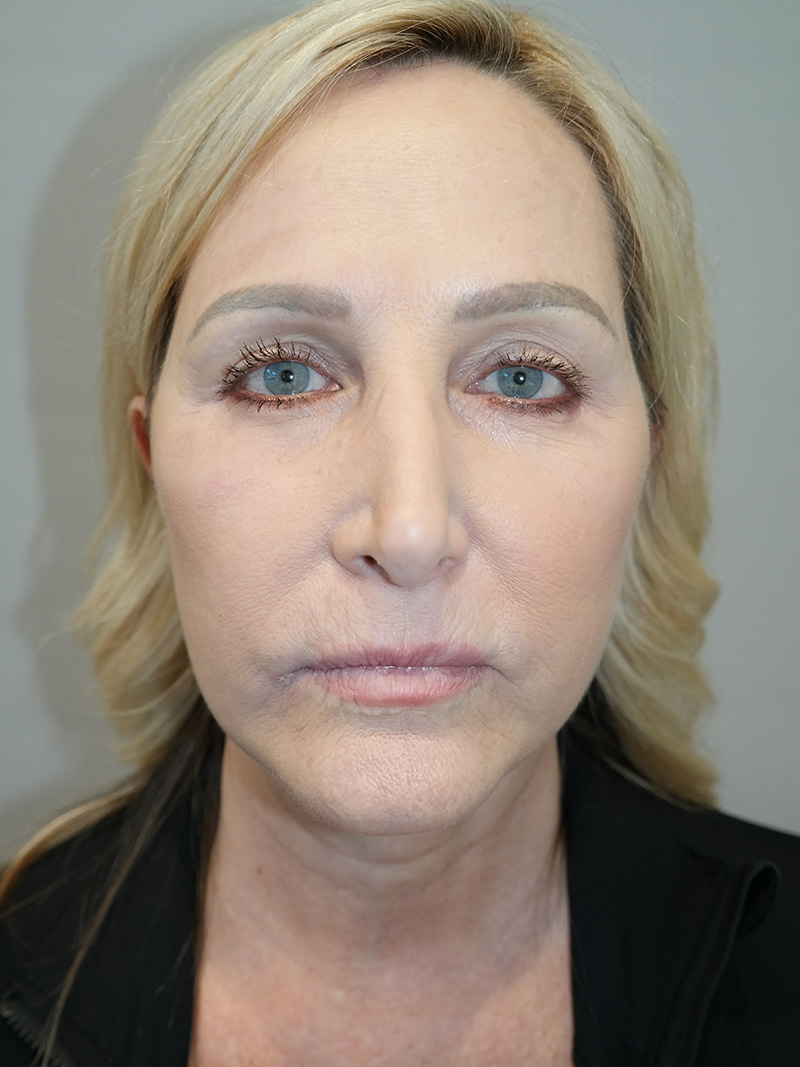 Facelift Before and After 16 | Sanjay Grover MD FACS