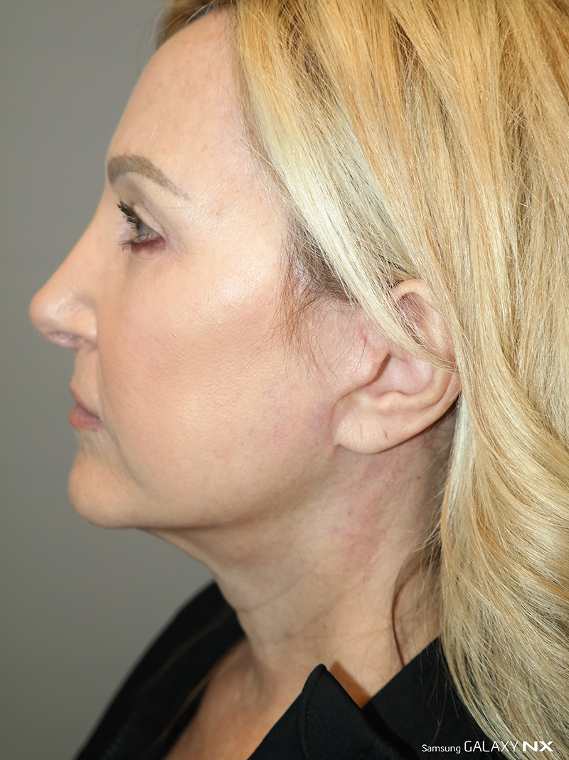 Facelift Before and After 16 | Sanjay Grover MD FACS