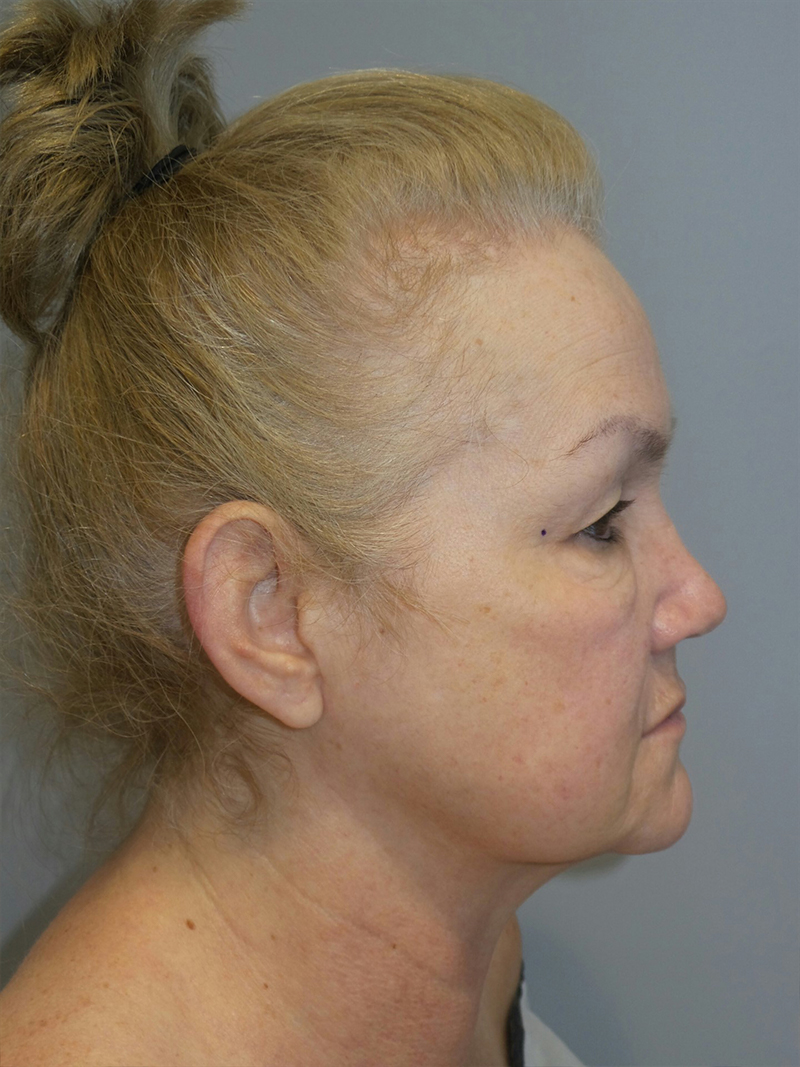 Facelift Before and After 17 | Sanjay Grover MD FACS