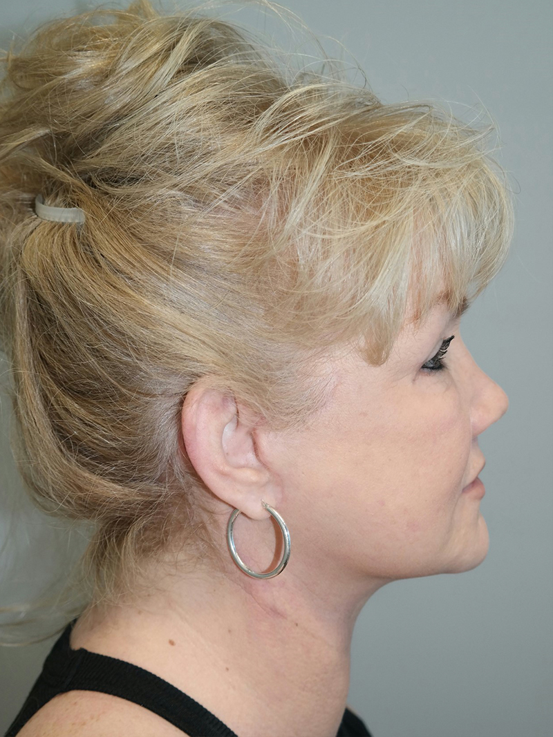 Facelift Before and After 17 | Sanjay Grover MD FACS