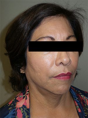 Facelift Before and After 23 | Sanjay Grover MD FACS