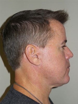 Facelift Before and After 18 | Sanjay Grover MD FACS