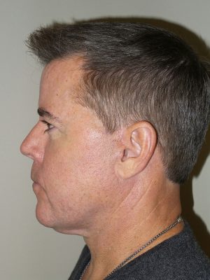 Facelift Before and After 18 | Sanjay Grover MD FACS