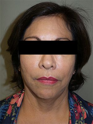 Facelift Before and After 18 | Sanjay Grover MD FACS