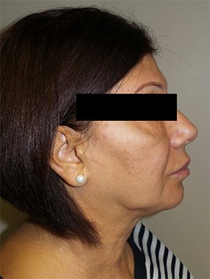 Facelift Before and After 19 | Sanjay Grover MD FACS