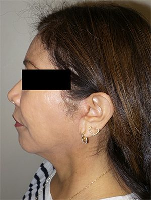 Facelift Before and After 19 | Sanjay Grover MD FACS