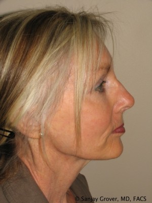 Facelift Before and After 23 | Sanjay Grover MD FACS