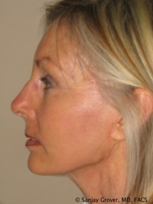 Facelift Before and After 23 | Sanjay Grover MD FACS