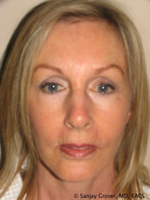 Facelift Before and After 23 | Sanjay Grover MD FACS