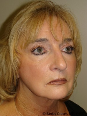 Facelift Before and After 24 | Sanjay Grover MD FACS