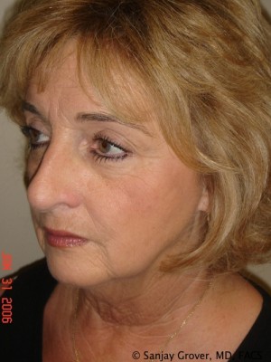 Facelift Before and After 24 | Sanjay Grover MD FACS