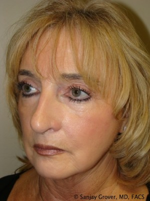 Facelift Before and After 25 | Sanjay Grover MD FACS