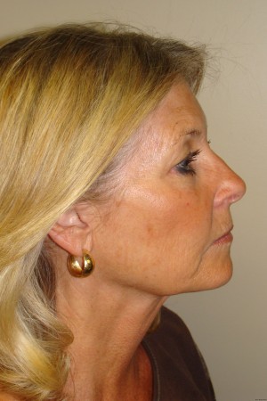 Facelift Before and After 25 | Sanjay Grover MD FACS