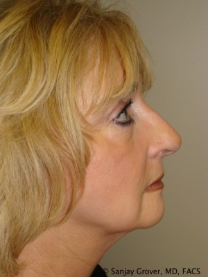 Facelift Before and After 25 | Sanjay Grover MD FACS