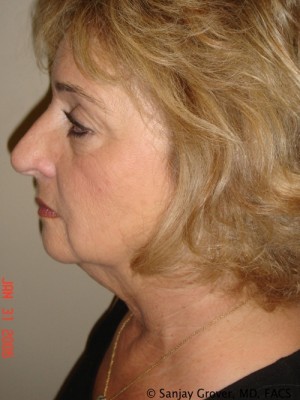 Facelift Before and After 25 | Sanjay Grover MD FACS