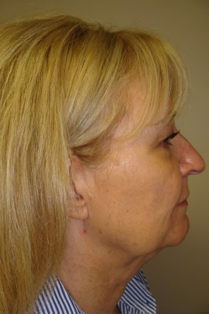 Facelift Before and After 29 | Sanjay Grover MD FACS