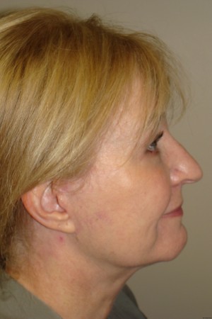 Facelift Before and After 29 | Sanjay Grover MD FACS