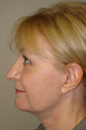 Facelift Before and After 29 | Sanjay Grover MD FACS