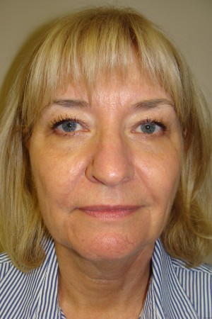 Facelift Before and After 29 | Sanjay Grover MD FACS