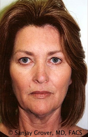 Facelift Before and After 33 | Sanjay Grover MD FACS