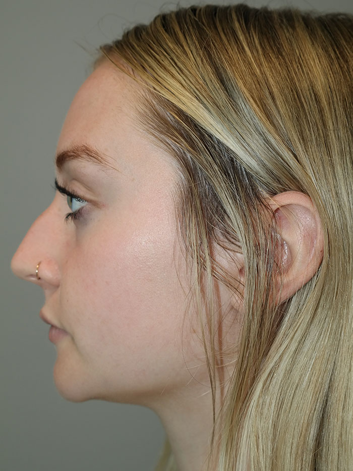 Rhinoplasty Before and After 02 | Sanjay Grover MD FACS