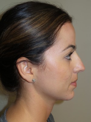 Rhinoplasty Before and After 05 | Sanjay Grover MD FACS