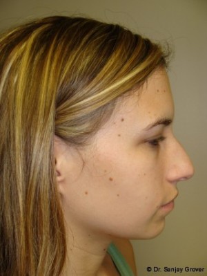 Rhinoplasty Before and After 34 | Sanjay Grover MD FACS