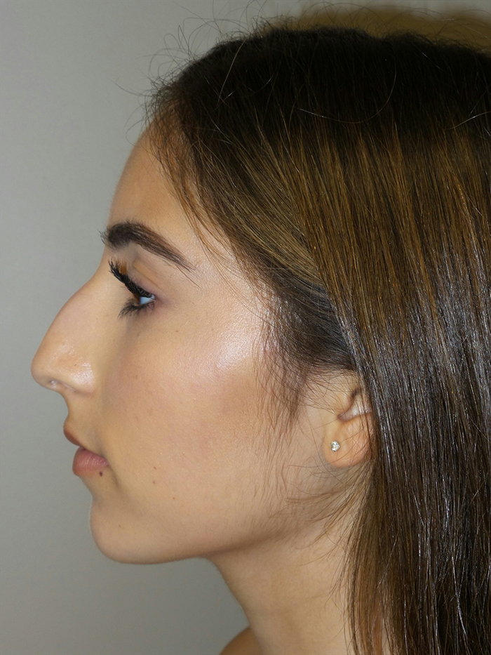 Rhinoplasty Before and After 08 | Sanjay Grover MD FACS