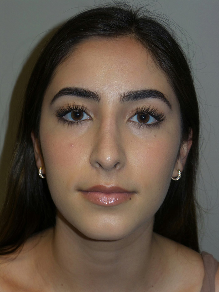 Rhinoplasty Before and After 08 | Sanjay Grover MD FACS