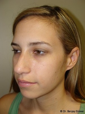 Rhinoplasty Before and After 09 | Sanjay Grover MD FACS