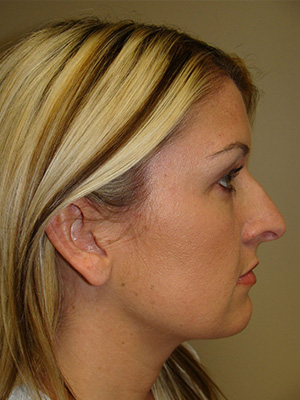 Rhinoplasty Before and After 11 | Sanjay Grover MD FACS